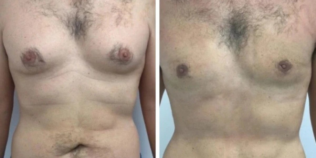 How Safe and Advanced Treatments Have Improved Gynecomastia in Dubai Outcomes