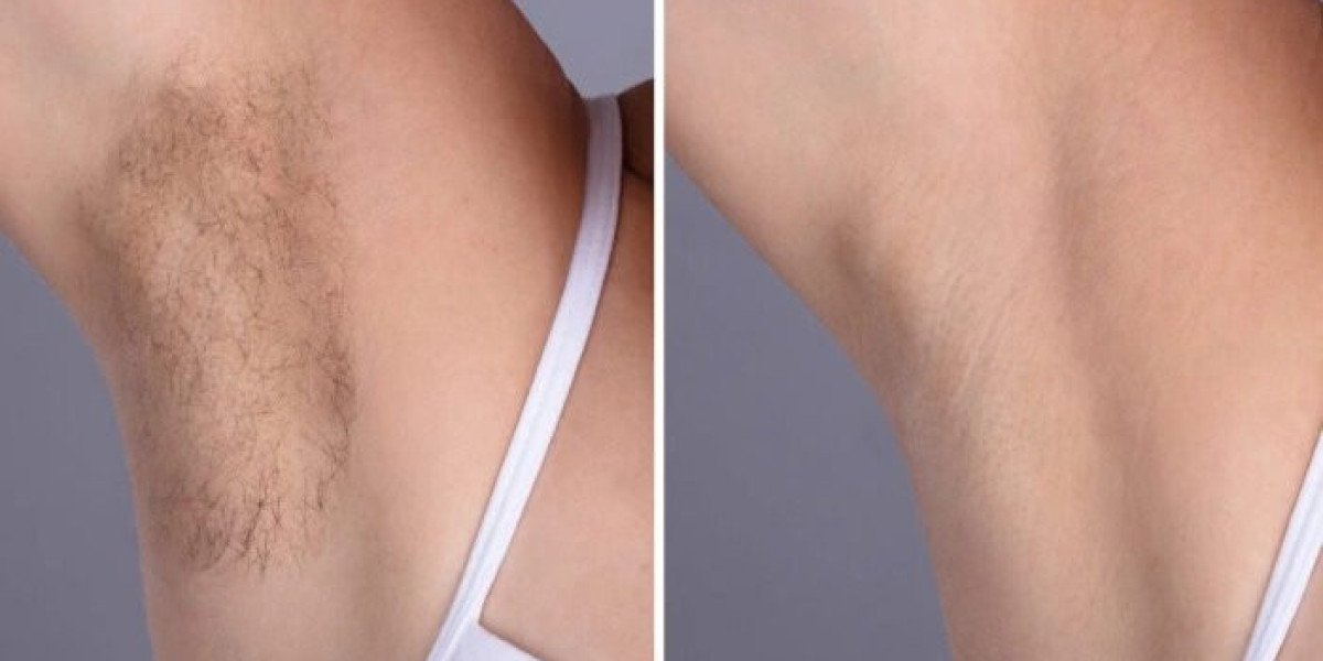 Laser hair removal in Dubai: Achieving Smooth Skin with Confidence