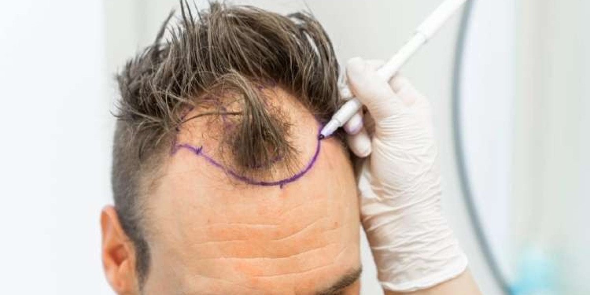 Hair Transplant for Teenagers: Ethical and Medical Considerations