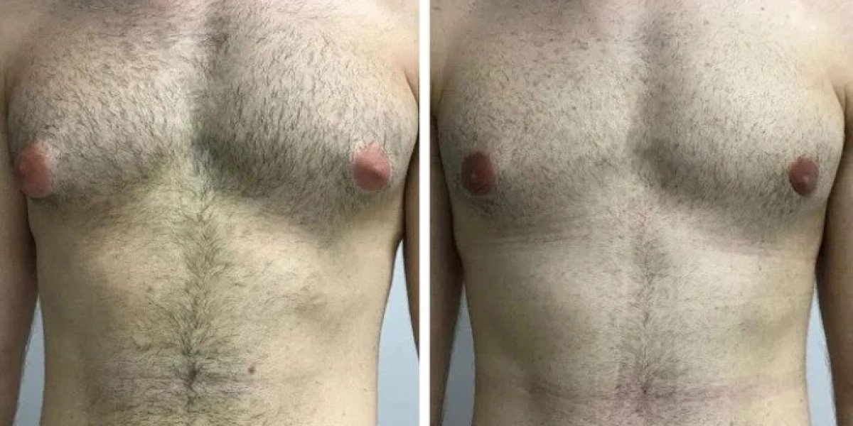 Gynecomastia in Dubai: How Advanced Technology Improves Results