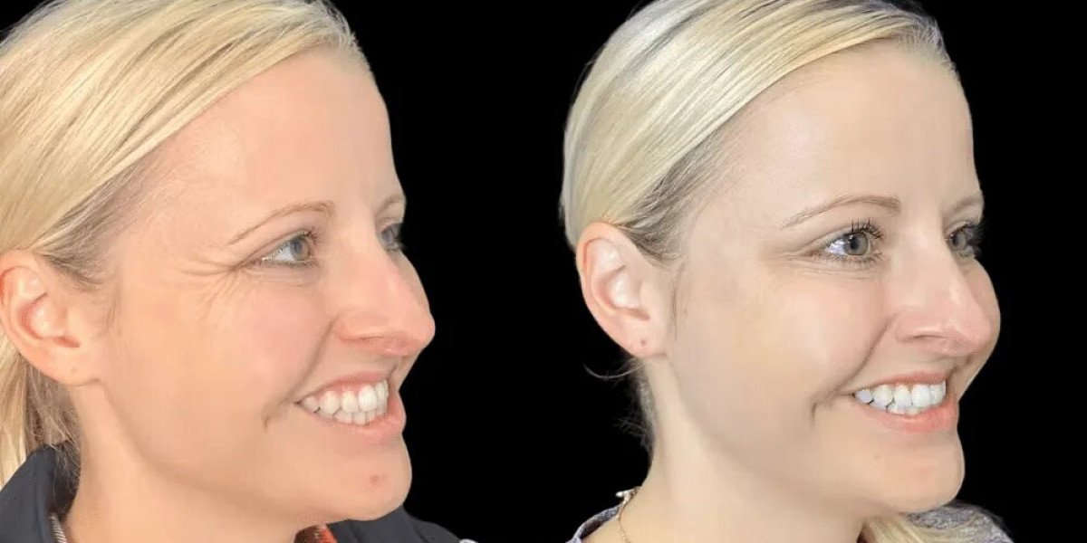 How to Maintain Botox Results According to the Best Plastic Surgeon in dubai