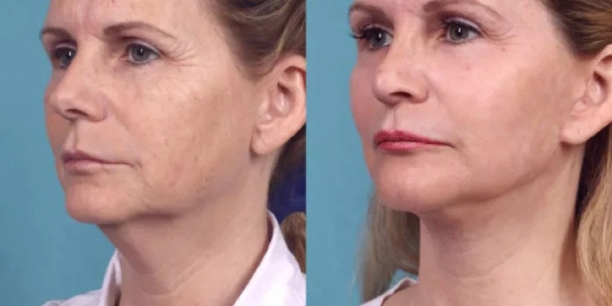 Best Plastic Surgeons in Dubai for Cosmetic Facial Peeling