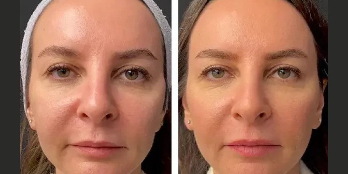 Best Plastic Surgeon in Dubai for Anti-Aging and Youthful Skin with Mesotherapy
