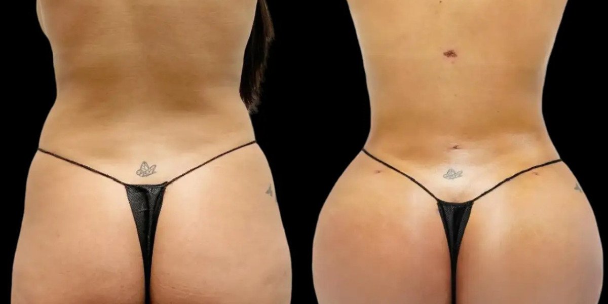 What to Expect During Your Fat Transfer in Dubai Consultation