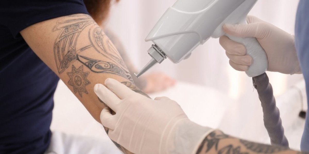 The science behind laser tattoo removal technology