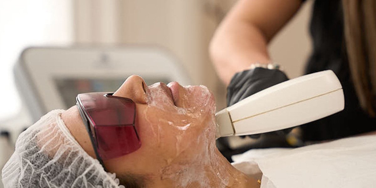 Laser For Rosacea In London: Professional Laser Solutions to Calm Facial Redness