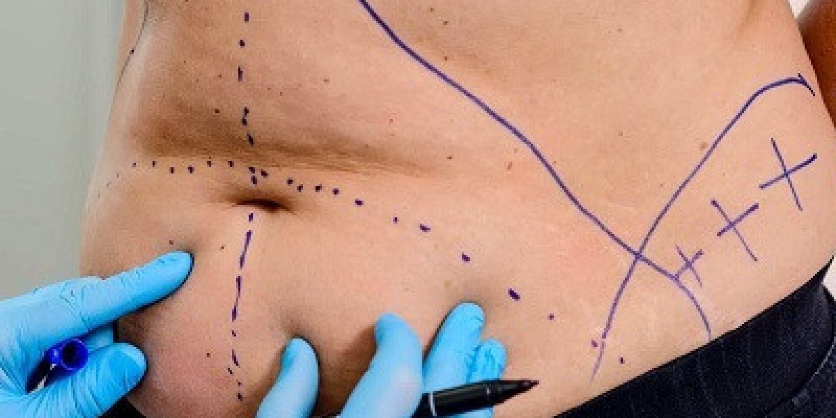 Liposuction for a Slimmer Look Riyadh