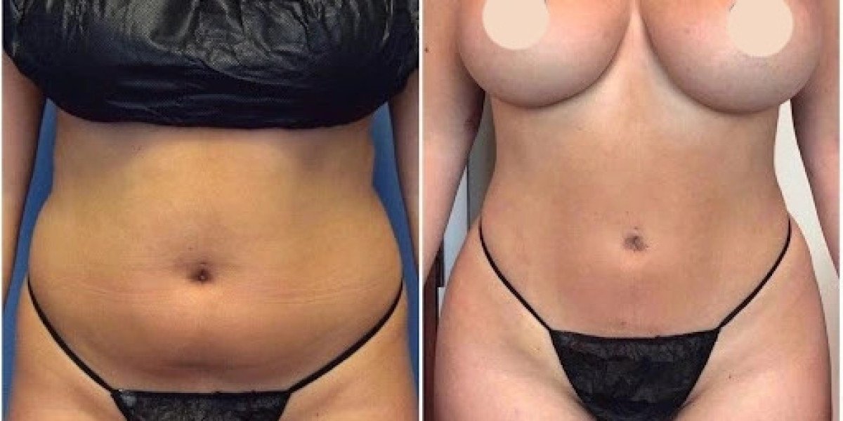 Get Younger-Looking Skin Fast with J-Plasma Treatment in Dubai