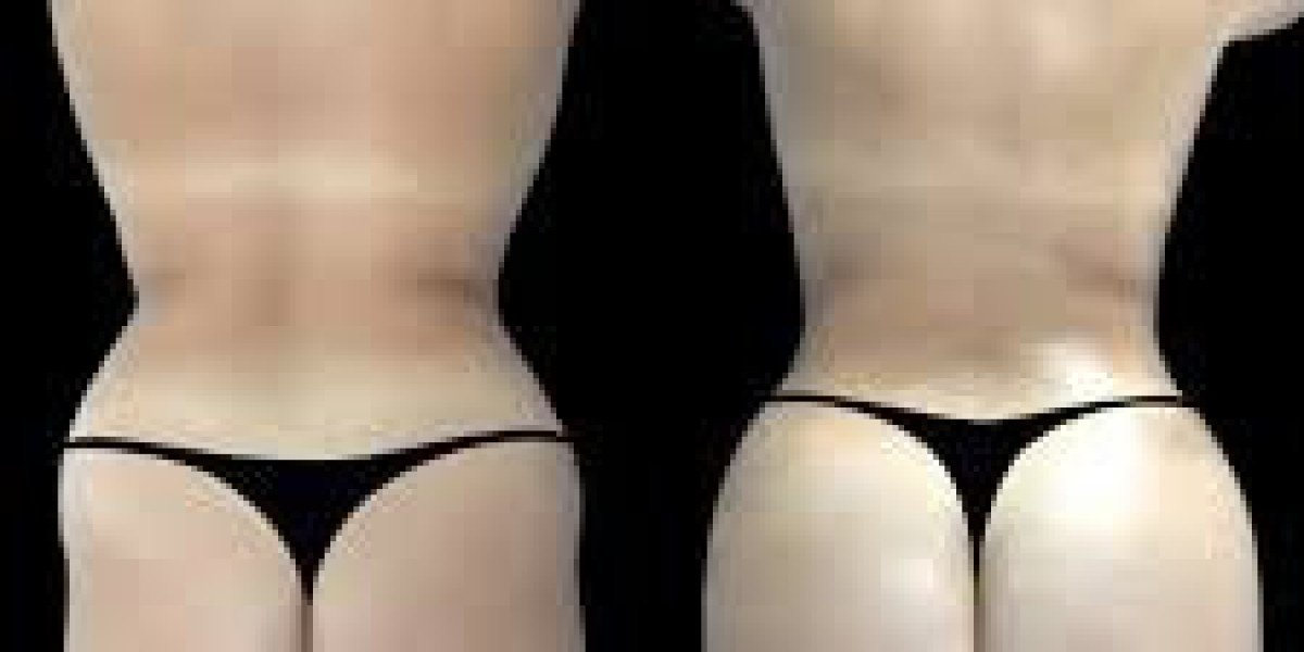 Butt Fat Transfer in Dubai for Curvier Body Shapes