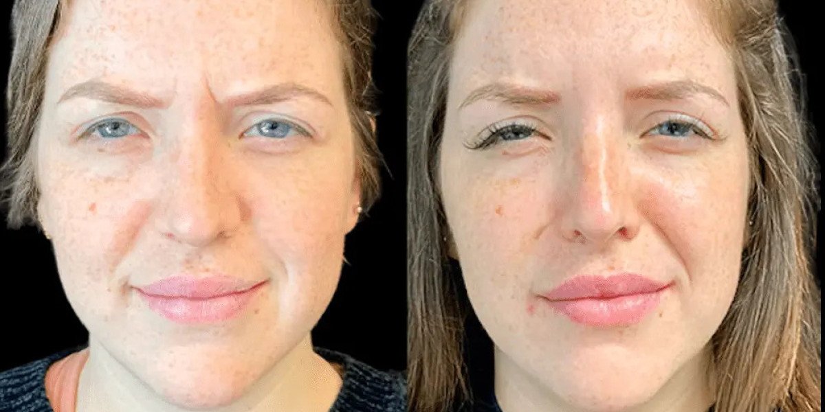 Best Doctors in Dubai for Botox: Latest Trends in Cosmetic Treatments