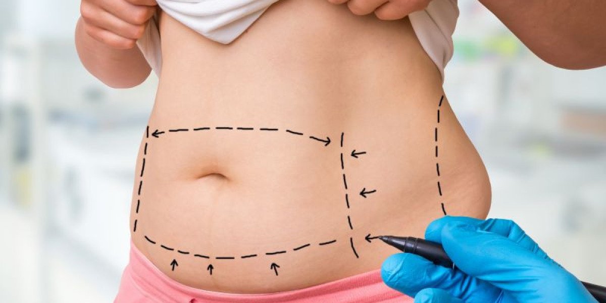 Cost of Tummy Tuck in Islamabad: Complete Breakdown